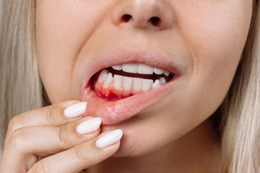خونریزی لثه را چه زمانی باید جدی گرفت؟